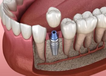 Implantes dentales