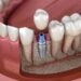 Implantes dentales