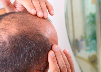 alopecia