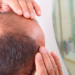 alopecia