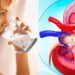 Litiasis renal