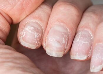 Estrías en las uñas ¿por qué aparecen y cómo tratarlas?