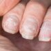 Estrías en las uñas ¿por qué aparecen y cómo tratarlas?