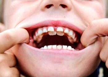 Dientes supernumerarios en los niños