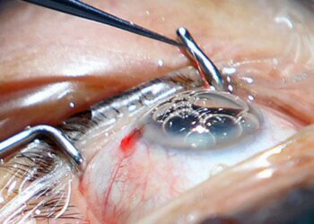 ¡Conoce todo lo que debes saber sobre las cataratas y su operación!